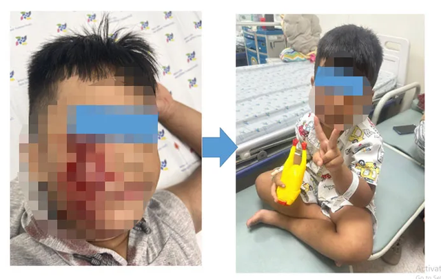 Đang chơi đùa, bé trai bị chó cắn rách má phải