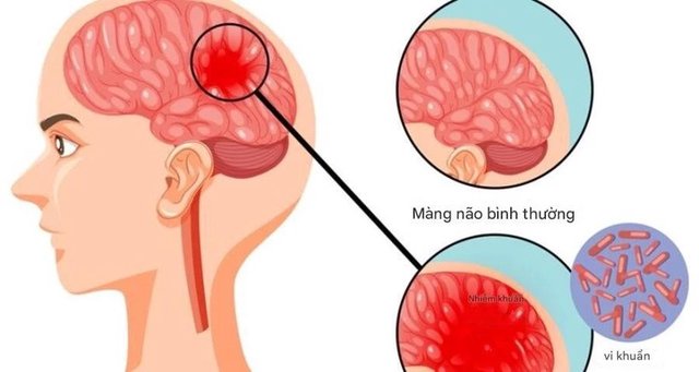 Bệnh não mô cầu xuất hiện trong trường học: Những dấu hiệu phụ huynh không thể bỏ qua