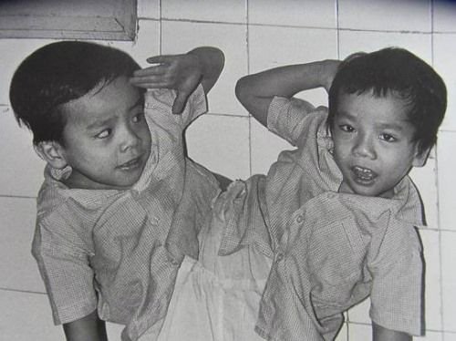 Cặp song sinh Việt - Đức