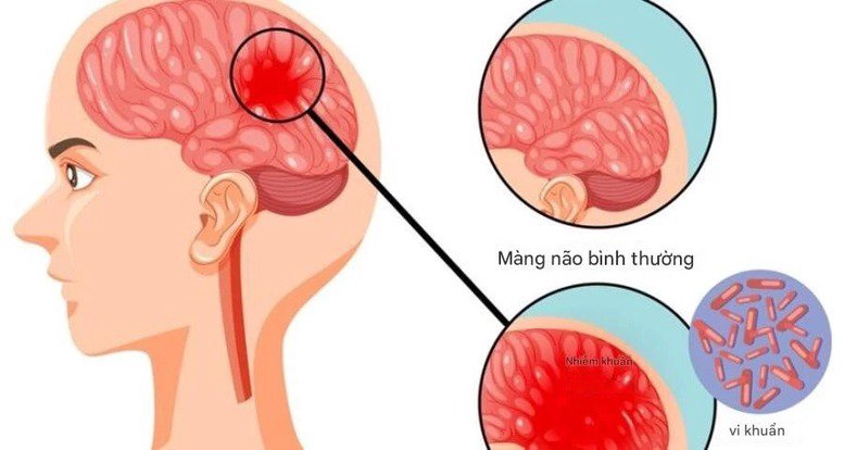 Tác nhân gây bệnh não mô cầu là vi khuẩn Neisseria meningitidis. Ảnh: baochinhphu.vn